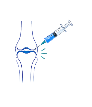 Platelet-rich plasma knee injection illustration